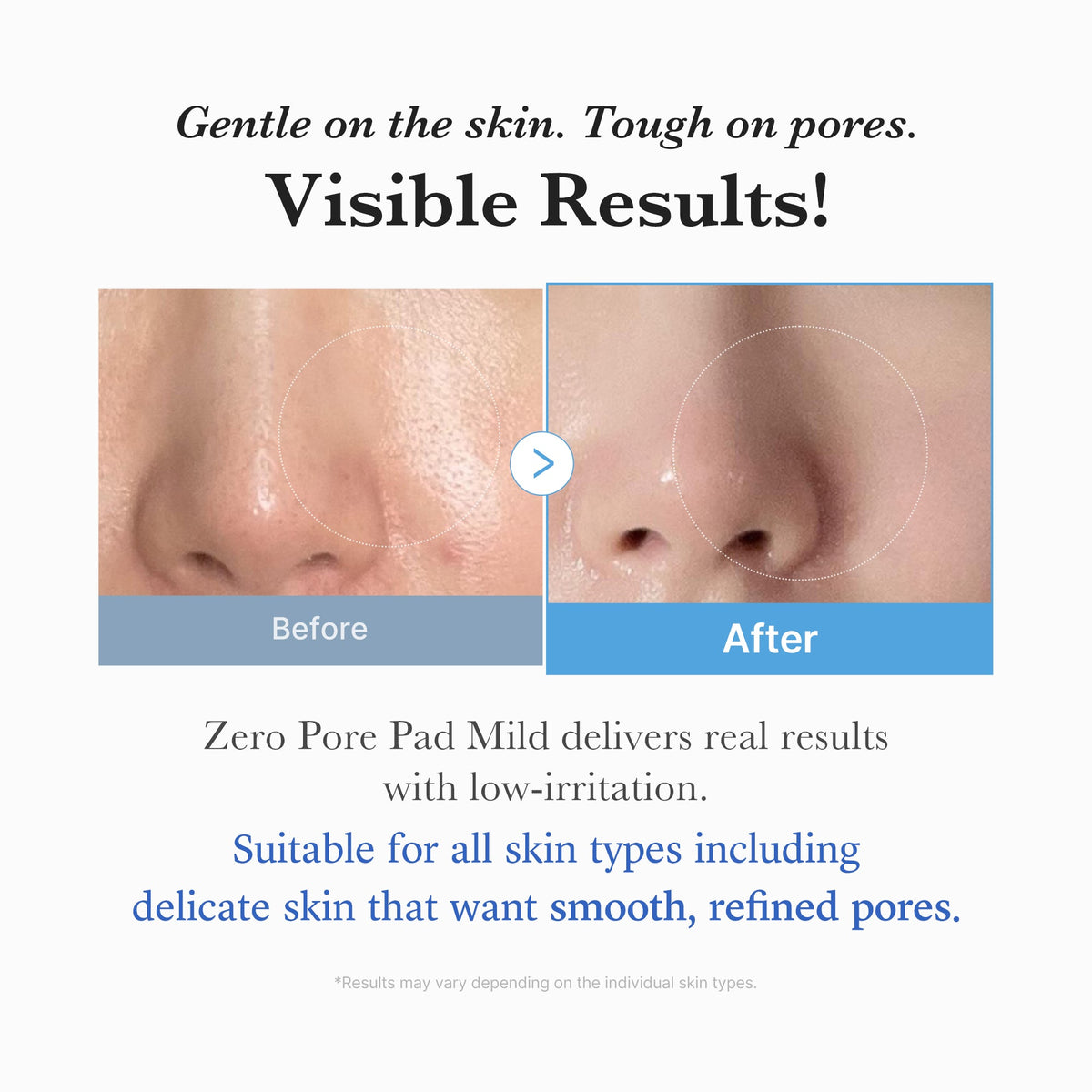 Zero Pore Madecassoside Pads (Mild) E2